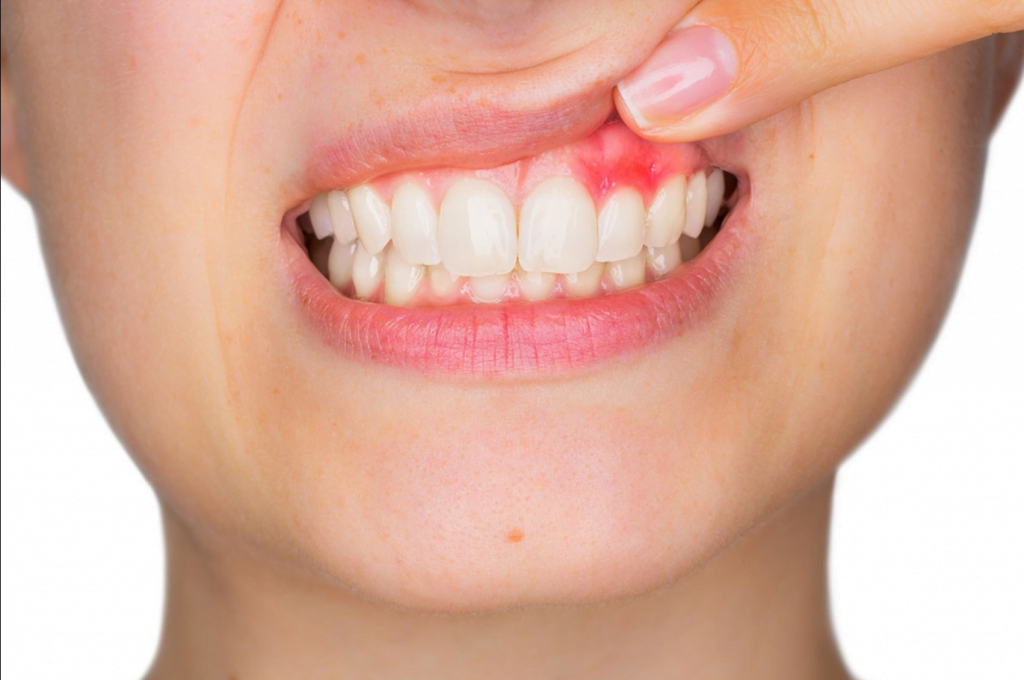 La periodontitis agrava la infección por Covid